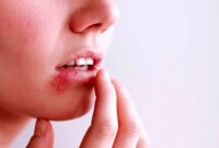 آیا می‌توان از شر تبخال به‌طور دائمی خلاص شد؟