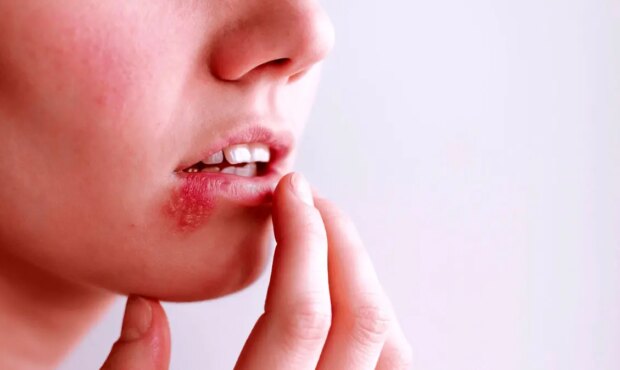 آیا می‌توان از شر تبخال به‌طور دائمی خلاص شد؟