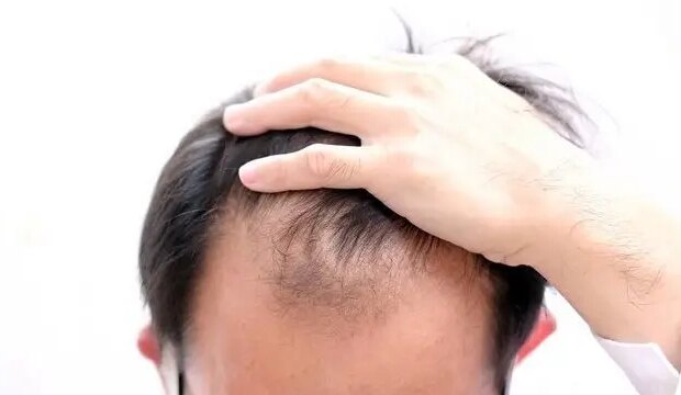 چرا موها دچار ریزش می شود؟ از علل تا درمان